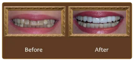 implants_greenacres dentures_greenacres